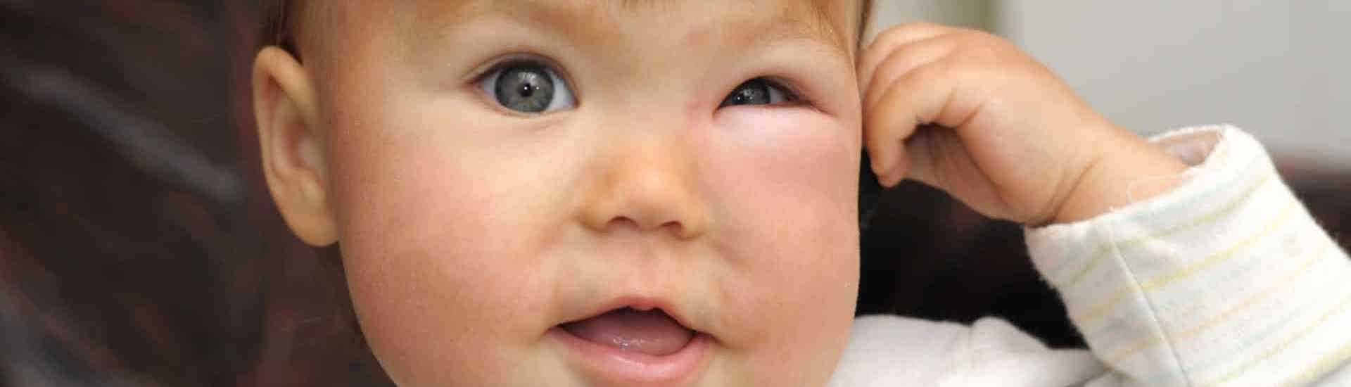 Baby met steken en beten aan oog: hoe bescherm je je kinderen? 
